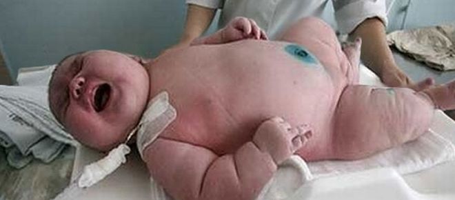Αυστραλία: Μωρό γεννήθηκε 18 κιλά και είναι το μεγαλύτερο σε όλο το κόσμο